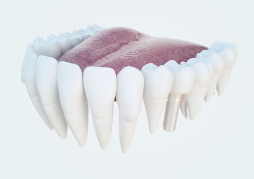 Dental implant with crown in a denture model