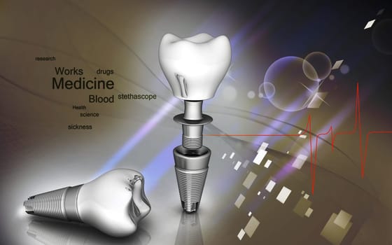 Digital illustration of Dental implant in colour background