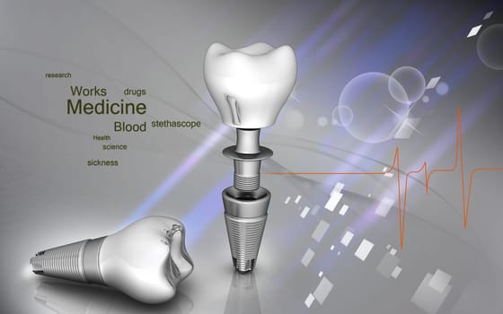 Digital illustration of Dental implant in colour background