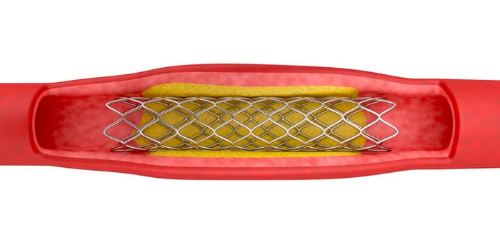 Angioplasty with stent placement, 3d illustration