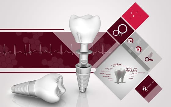 Dental implant