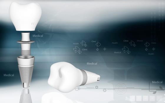 Digital illustration of Dental implant in colour background