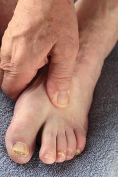 A senior man with a fungal infection on some of his toes
