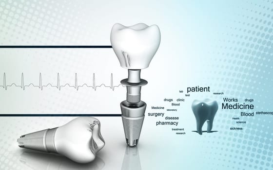 Digital illustration of Dental implant in colour background