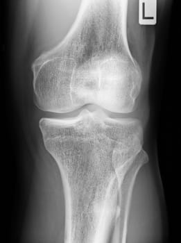 Human knee as xray