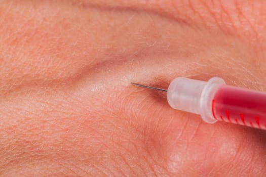 Small syringe with needle in the skin vein vein blood drugs medicine as Macro close-up