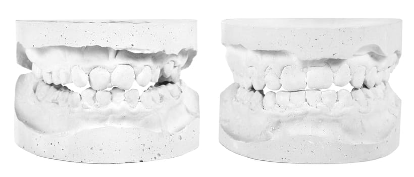 Plaster prints before and after treatment