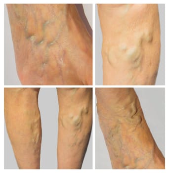 The varicose veins on a legs of old woman on gray