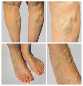 The varicose veins on a legs of old woman on gray