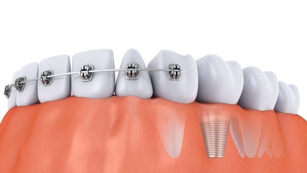 a teeth with braces and dental implants, 3d render