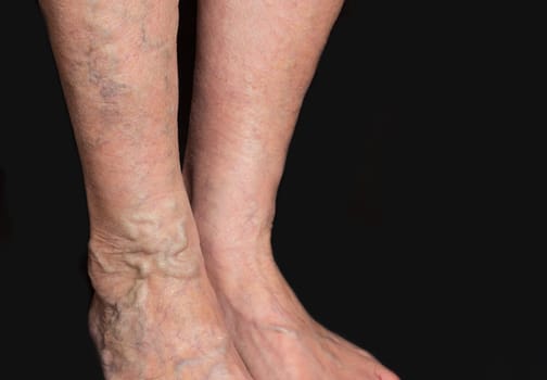 The varicose veins on a legs of old woman on black