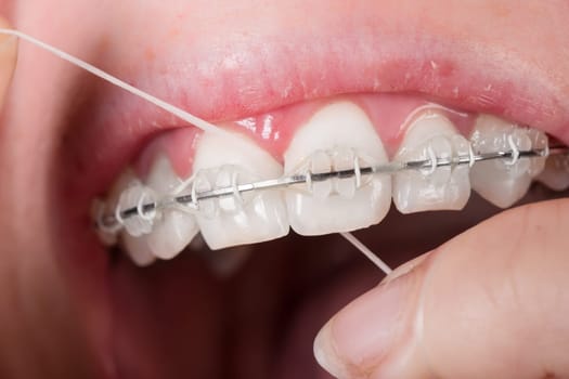 Mouth with tooth clip
