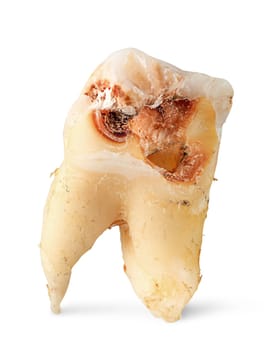 Closeup single tooth with caries vertically isolated on white background
