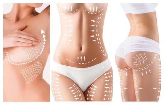 The cellulite removal plan. White markings on young woman body preparing for plastic surgery. Concept of slimming, liposuction, strand lifting