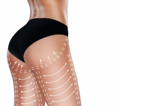 Marks on the women's buttocks, waist and legs before plastic surgery. The concept of plastic surgery