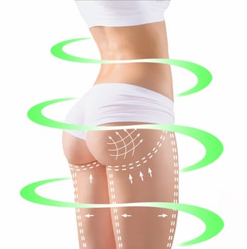 Marks on the women's buttocks, waist and legs before plastic surgery. The concept of plastic surgery