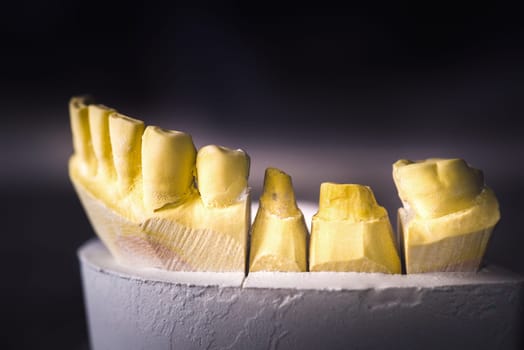 Dental prosthesis, artificial tooth. Photo of artificial teeth made in the dental laboratory.