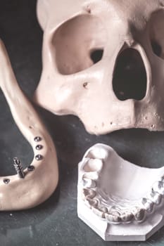 Dental prosthesis, artificial tooth. Photo of artificial teeth made in the dental laboratory.