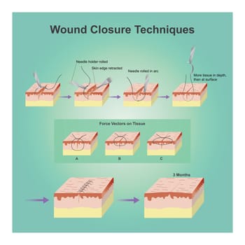 A wound is a type of injury which happens relatively quickly in which skin is torn, cut, or punctured (an open wound),or where blunt force trauma causes a contusion.