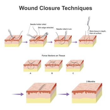 A wound is a type of injury which happens relatively quickly in which skin is torn, cut, or punctured (an open wound),or where blunt force trauma causes a contusion.