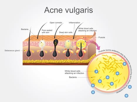 Acne vulgaris is a long-term skin disease that occurs when hair follicles become clogged with dead skin cells and oil from the skin. Acne is characterized by areas of blackheads, whiteheads, pimples, and greasy skin, and may result in scarring.