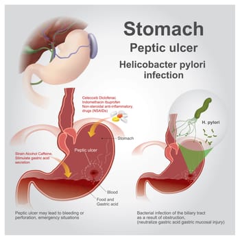 Eptic ulcer disease, also known as a peptic ulcer or stomach ulcer, is a break in the lining of the stomach, first part of the small intestine, or occasionally the lower esophagus. An ulcer in the stomach is known as a gastric ulcer while that in the first part of the intestines is known as a duodenal ulcer.