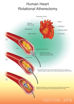 Atherectomy is a procedure which is performed to remove atherosclerotic plaque from diseased arteries. Atherosclerotic plaques are localized in either coronary