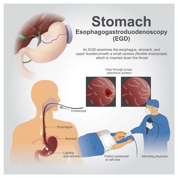 Esophagogastroduodenoscopy, also called by various other names, is a diagnostic endoscopic procedure that visualizes the upper part of the gastrointestinal tract up to the duodenum.