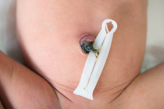 Umbilical cord with clamp of newborn baby, 7 days old.