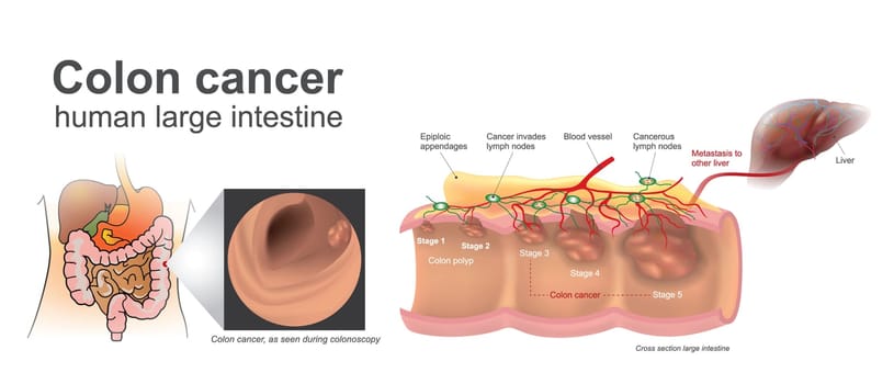 The cancer invades the blood and lymph systems, malignant systems, malignant cells can break off and spread to other liver. Anatomy Illustration.