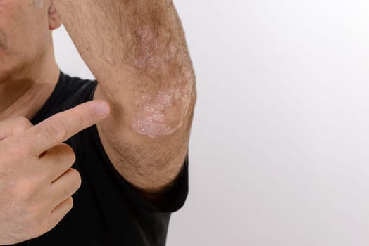 Psoriasis is a chronic inflammatory disease of the skin. Detail of the elbow. Blank space.