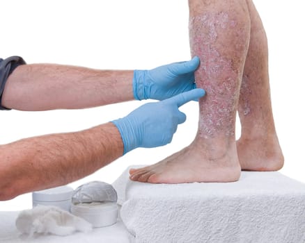 Psoriasis is a chronic inflammatory disease of the skin. Dermatologist visits the patient in the clinic, detail of the legs