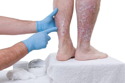 Psoriasis is a chronic inflammatory disease of the skin. Dermatologist visits the patient in the clinic, detail of the legs