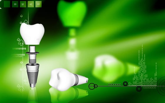 Digital illustration Dental implant in colour background