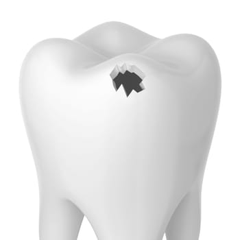 Hole in a tooth. 3d illustration isolated on white background