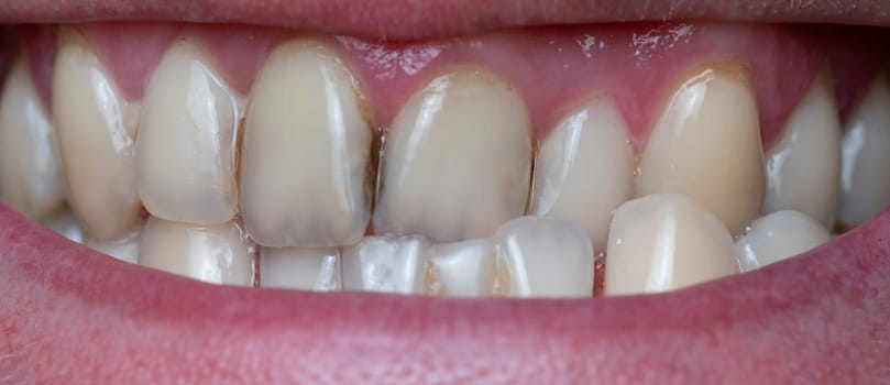 Closeup of dental plaque on man's teeth caused by coffee residual