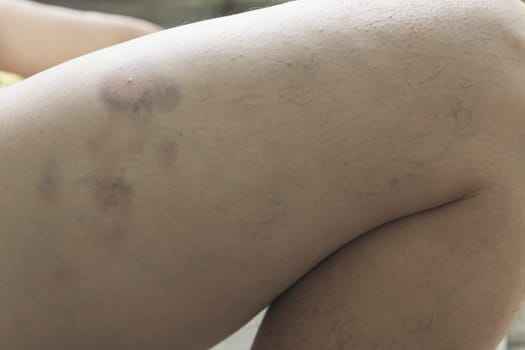 Body pain. close-up female body with pain in legs. Painful concept.