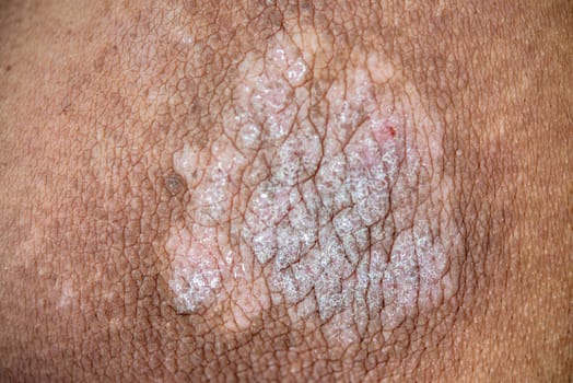 Psoriasis on man skin, close up.