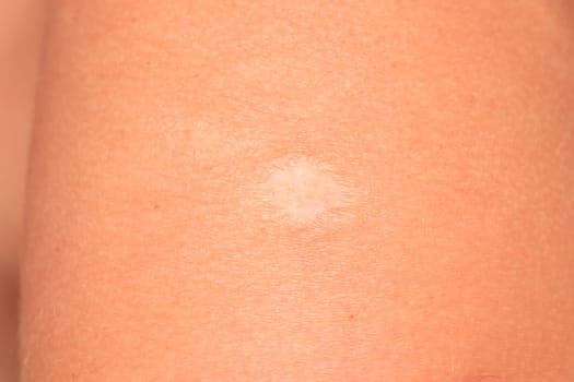 Vaccine scar on the skin