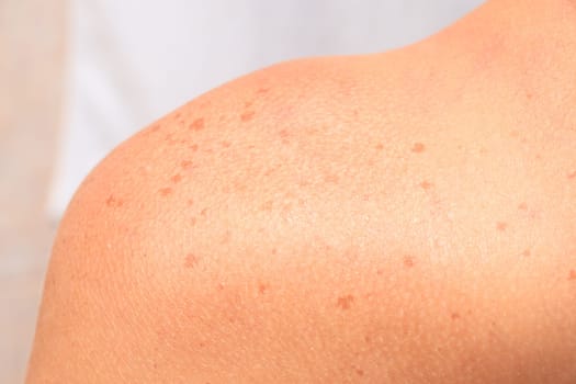 Skin of a womans shoulder with birthmarks