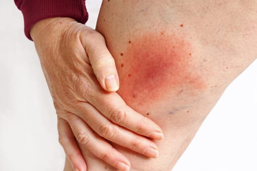Wandering flush Lyme borreliosis of the leg of a woman transmitted by a tick. Lyme disease caused by a tick bite on the thigh.