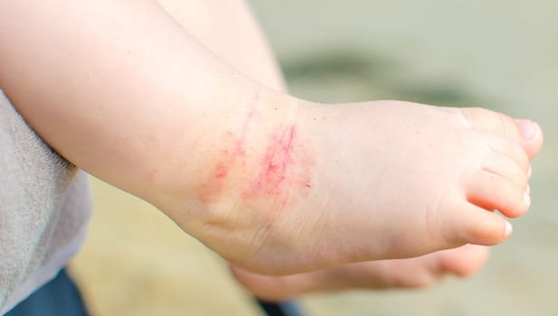 itchy dermatitis atopic baby foot
