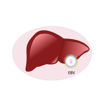 Mononucleosis virus  infection in liver disorder vector illustration  on the white background