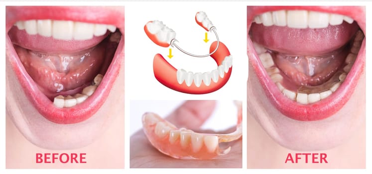 Dental rehabilitation with lower flexible nylon denture, before and after treatment. Removable dentures flexible, devoid of nylon, hypoallergenic exempt from monomer