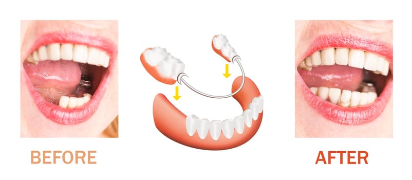 Dental rehabilitation with lower flexible nylon denture, before and after treatment. Removable dentures flexible, devoid of nylon, hypoallergenic exempt from monomer