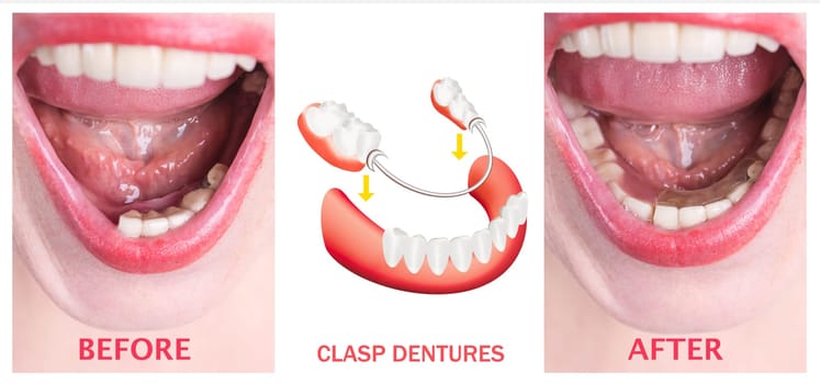 Dental rehabilitation with lower flexible nylon denture, before and after treatment. Removable dentures flexible, devoid of nylon, hypoallergenic exempt from monomer