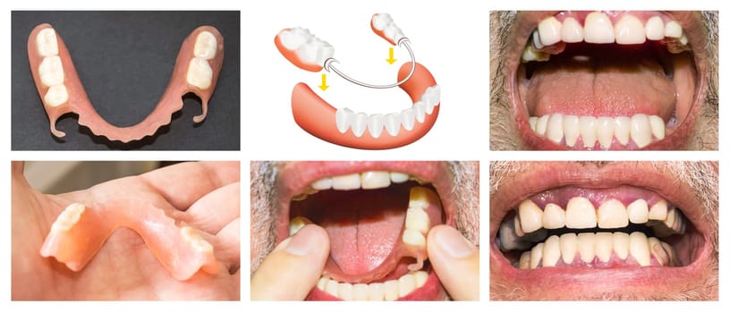 Dental rehabilitation with lower flexible nylon denture, before and after treatment. Removable dentures flexible, devoid of nylon, hypoallergenic exempt from monomer