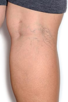 Close up varicose spider vein on skin crook leg elderly woman, Problem thrombosis that can cause blood vessel to clot, Vascular and venous diseases, Health care before the doctor on white background