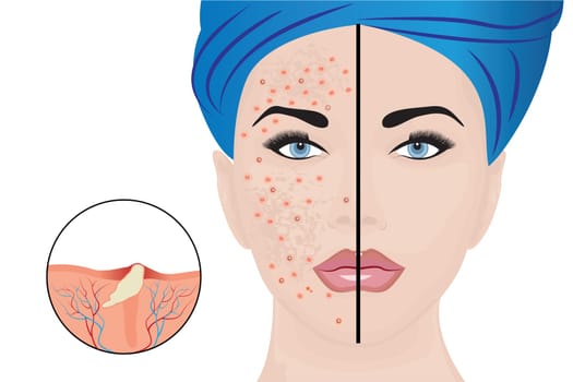 Acne pustules on a woman face and a treatment result before and after. vector illustration. Cosmetology concept, dermatology skin disease