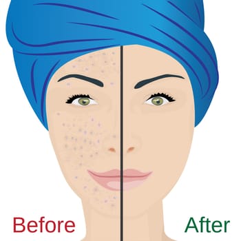 Acne pustules on a woman face and a treatment result before and after. vector illustration. Cosmetology concept, dermatology skin disease